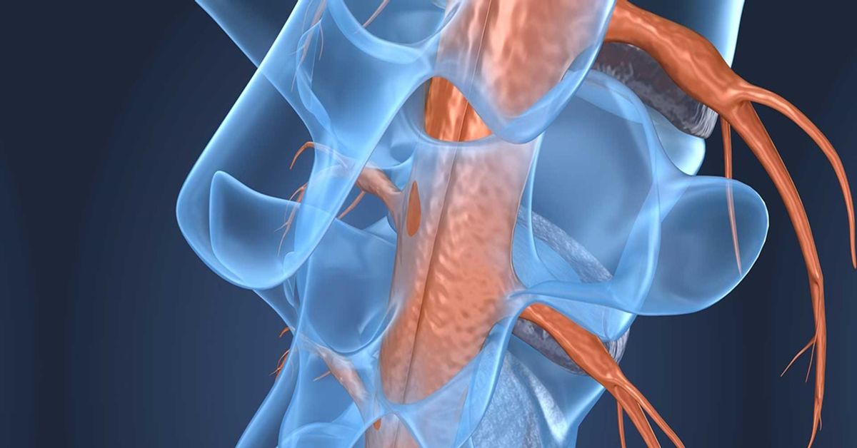 Spinal Cord Tumour